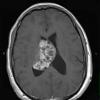 3A2 Ependymoma (Case 3) T1 W 1 - Copy