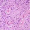 3B1pendymoma (Case 3)  H&E 1