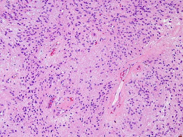 3B1pendymoma (Case 3)  H&E 1