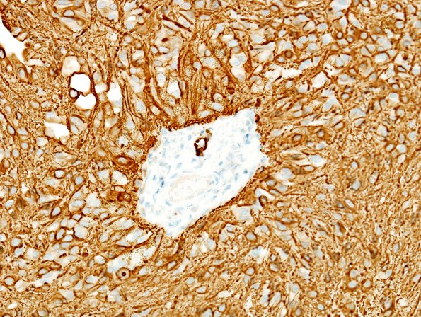 3C Ependymoma (Case 3)  GFAP