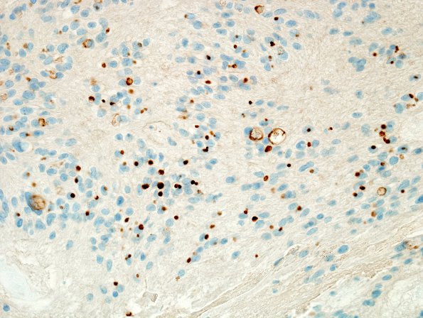 3D1  Ependymoma (Case 3)  EMA 1