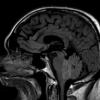 4A1 Ependymoma (Case 4) FLAIR 1 - Copy