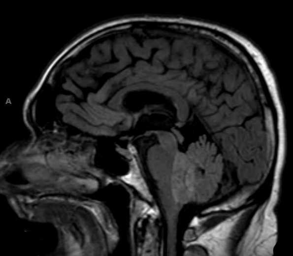 4A1 Ependymoma (Case 4) FLAIR 1 - Copy