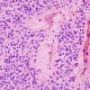 4B2 Ependymoma (Case 4) H&E 3