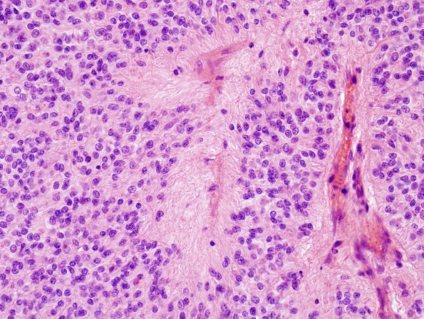 4B2 Ependymoma (Case 4) H&E 3