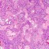 4B3 Ependymoma (Case 4) H&E 1