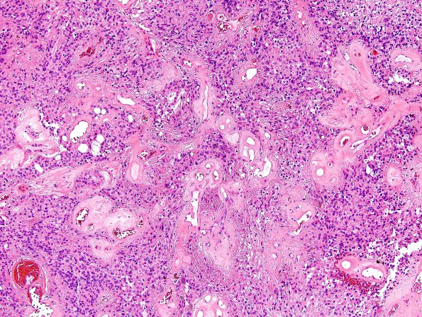 4B3 Ependymoma (Case 4) H&E 1