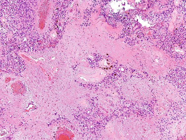 4B4 Ependymoma (Case 4) H&E 8