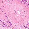 4B5 Ependymoma (Case 4) H&E 10