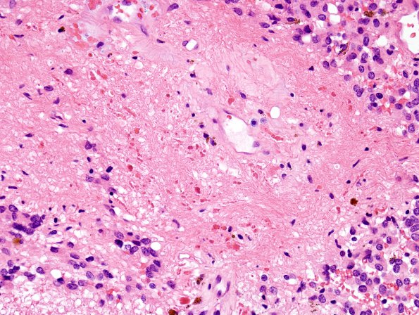 4B5 Ependymoma (Case 4) H&E 10