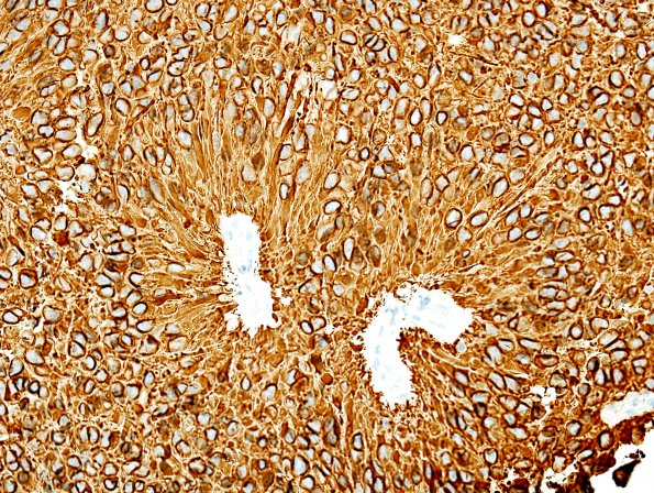 4C Ependymoma (Case 4) GFAP 1