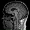 5A Ependymoma, WHO II (Case 5) T1 MPRAGE 1 - Copy