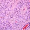 5B1 Ependymoma, WHO II (Case 5) H&E 1.jpg