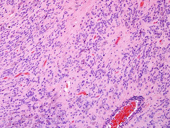 5B1 Ependymoma, WHO II (Case 5) H&E 1.jpg