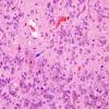 5B2 Ependymoma, WHO II (Case 5) H&E 4 copy.jpg