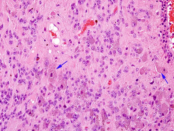 5B2 Ependymoma, WHO II (Case 5) H&E 4 copy.jpg