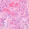 5B3 Ependymoma, WHO II amianthoid (Case 5) H&E 3.jpg