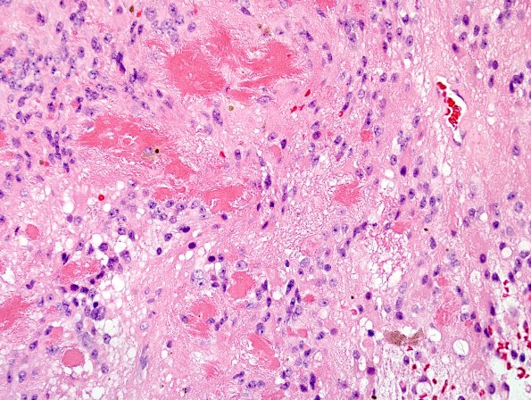 5B3 Ependymoma, WHO II amianthoid (Case 5) H&E 3.jpg