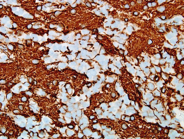 5C Ependymoma, WHO II (Case 5) GFAP 1.jpg