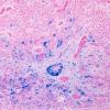 5D1 Ependymoma, WHO II (Case 5) Iron 1.jpg