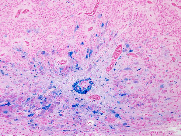 5D1 Ependymoma, WHO II (Case 5) Iron 1.jpg