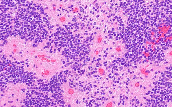 6A2 Ependymoma, anaplastic, RELA Fusion, WHO III (Case 6) H&E 3