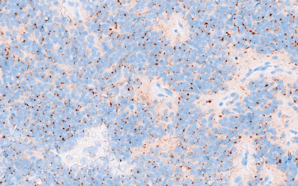 6C Ependymoma, anaplastic, RELA Fusion, WHO III (Case 6) D2-40 1