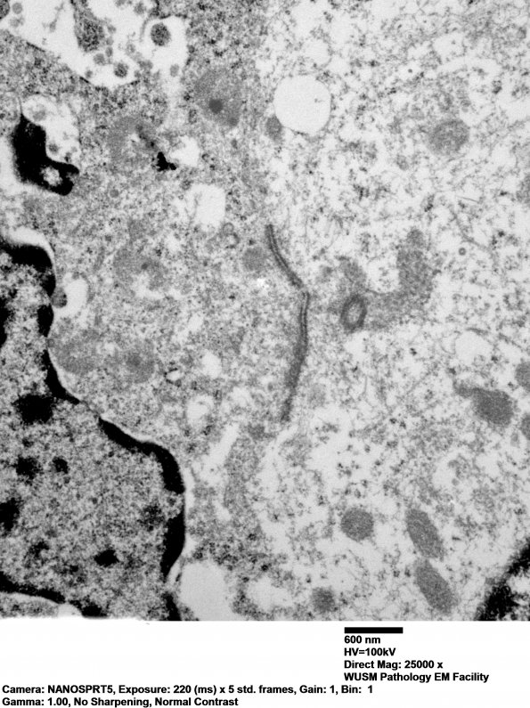 6D Ependymoma, anaplastic, RELA Fusion positive, WHO III (Case 6) EM 012 - Copy