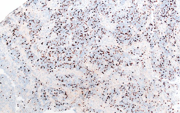 6E Ependymoma, anaplastic, RELA Fusion+, WHO III (Case 6) Ki67 1