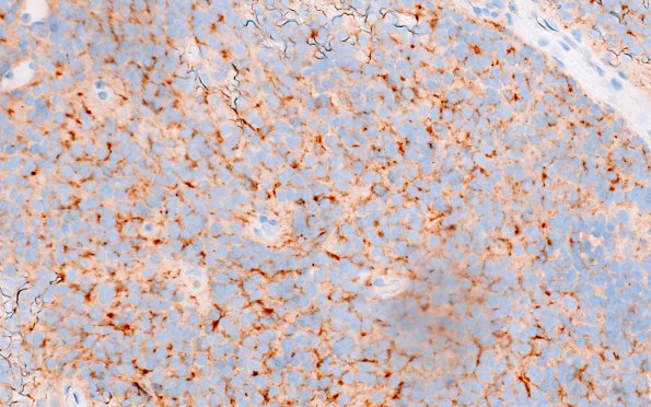 6F Ependymoma, anaplastic, RELA Fusion, WHO III (Case 6) SYN 1