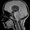 7A1 Ependymoma with focal anaplasia (Case 7) T1 - Copy