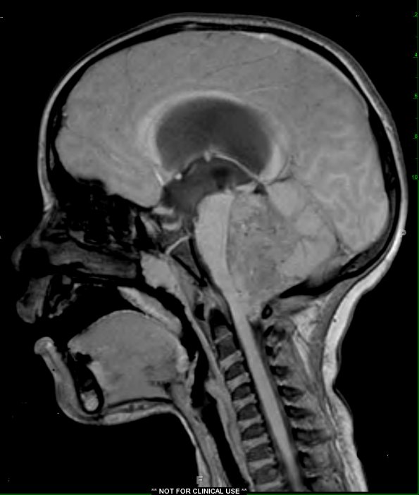 7A1 Ependymoma with focal anaplasia (Case 7) T1 - Copy