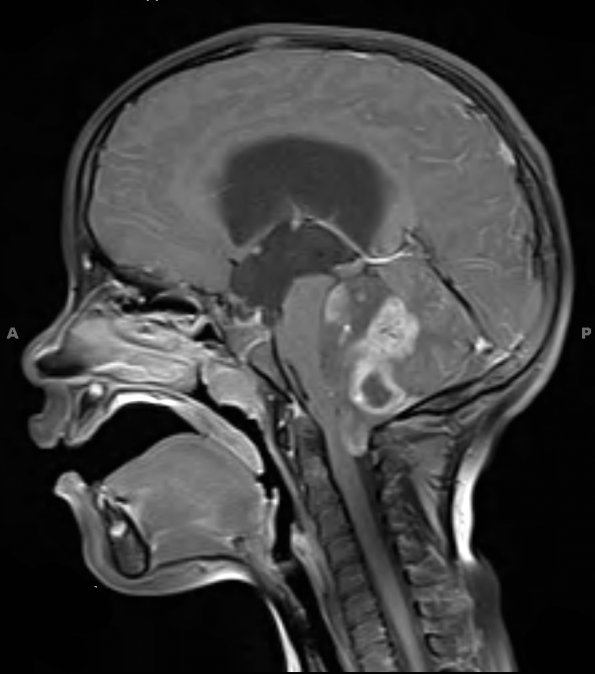 7A2 Ependymoma with focal anaplasia (Case 7) T1 W 1 - Copy