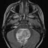 7A3 Ependymoma with focal anaplasia (Case 7) T2 2 - Copy