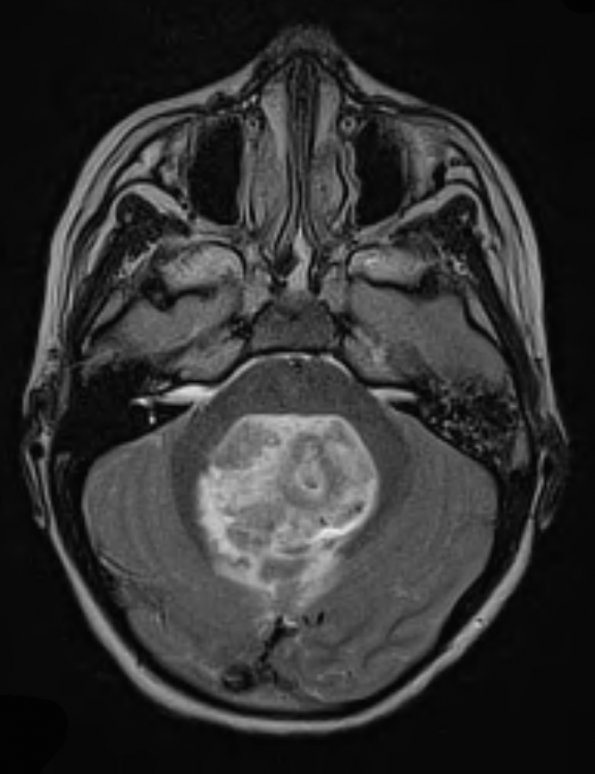 7A3 Ependymoma with focal anaplasia (Case 7) T2 2 - Copy