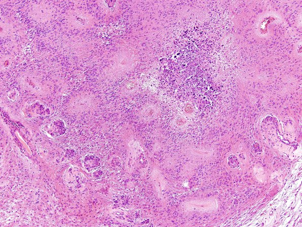 7B1 Ependymoma with focal anaplasia (Case 7) H&E 15