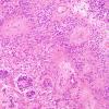 7B2 Ependymoma with focal anaplasia (Case 7) H&E 16