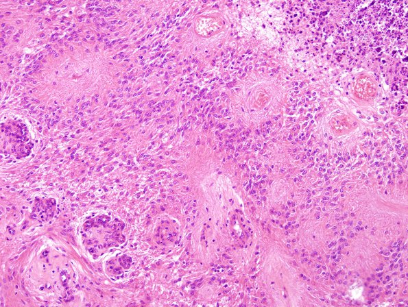 7B2 Ependymoma with focal anaplasia (Case 7) H&E 16