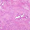 7B3 Ependymoma with focal anaplasia (Case 7) H&E 17