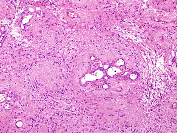 7B3 Ependymoma with focal anaplasia (Case 7) H&E 17