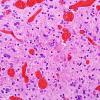 7B5 Ependymoma with focal anaplasia & Red Crunchies (Case 7) H&E 3