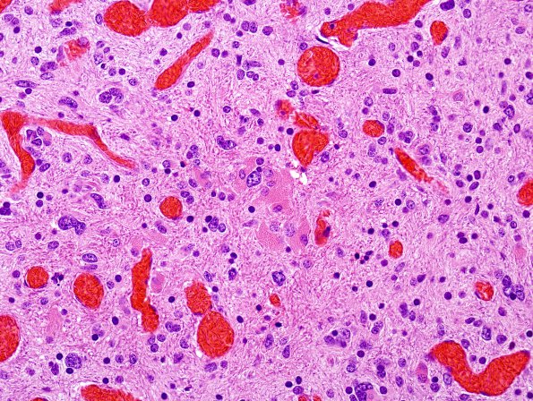 7B5 Ependymoma with focal anaplasia & Red Crunchies (Case 7) H&E 3