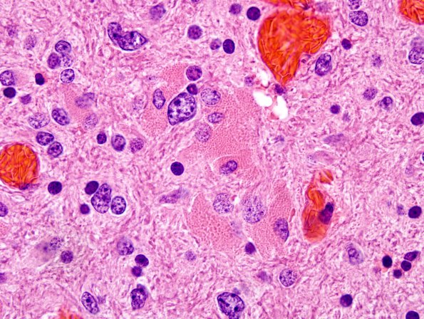 7B6 Ependymoma with focal anaplasia & Red Crunchies (Case 7) H&E 1