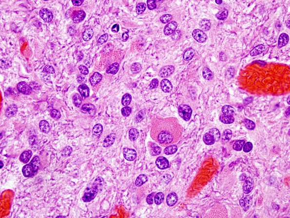 7B7 Ependymoma with focal anaplasia (Case 7) H&E 11