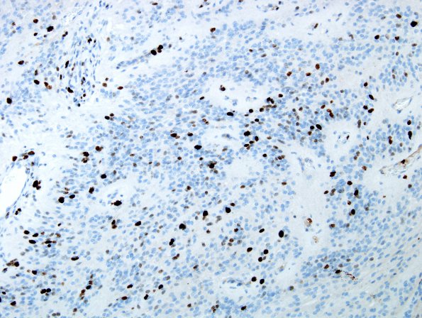 7C Ependymoma with focal anaplasia (Case 7) MIB 4