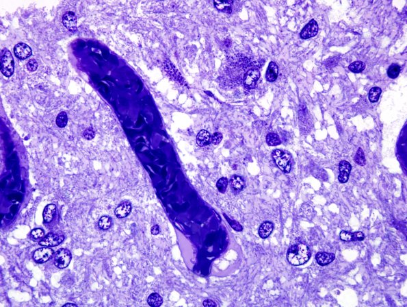 7D1 Ependymoma with focal anaplasia (Case 7) Plastic 4