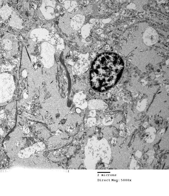 7E1 (Case 7) Ependymoma 011 - Copy