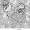 7E2 (Case 7) Ependymoma 004 - Copy