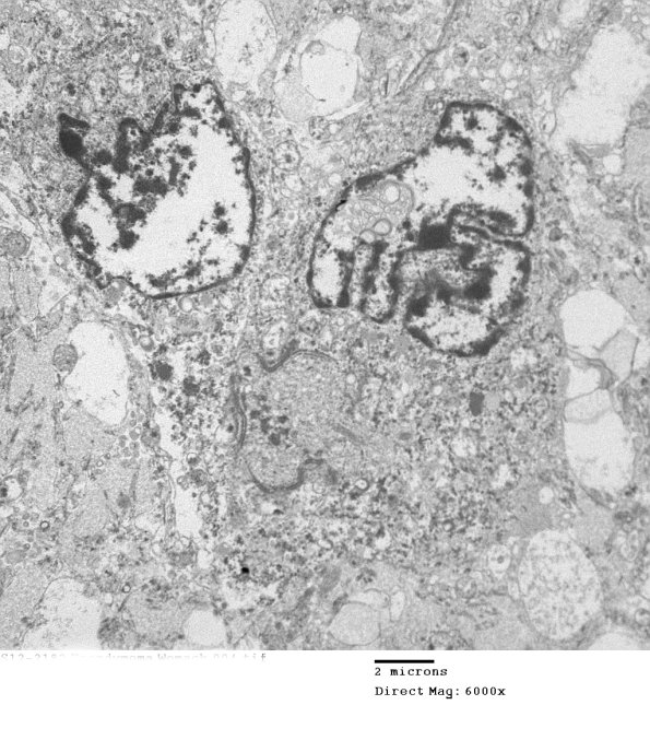 7E2 (Case 7) Ependymoma 004 - Copy