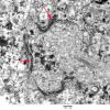 7E3 (Case 7) Ependymoma 005 copy - Copy